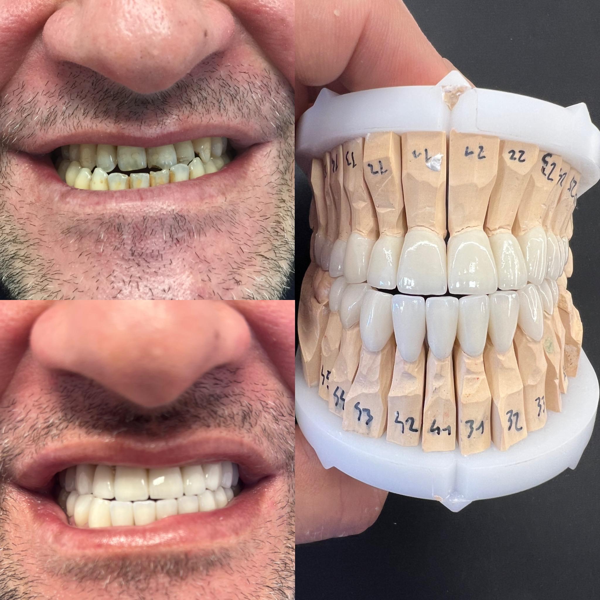 Avant / après : correction de l'occlusion avec couronnes zircone