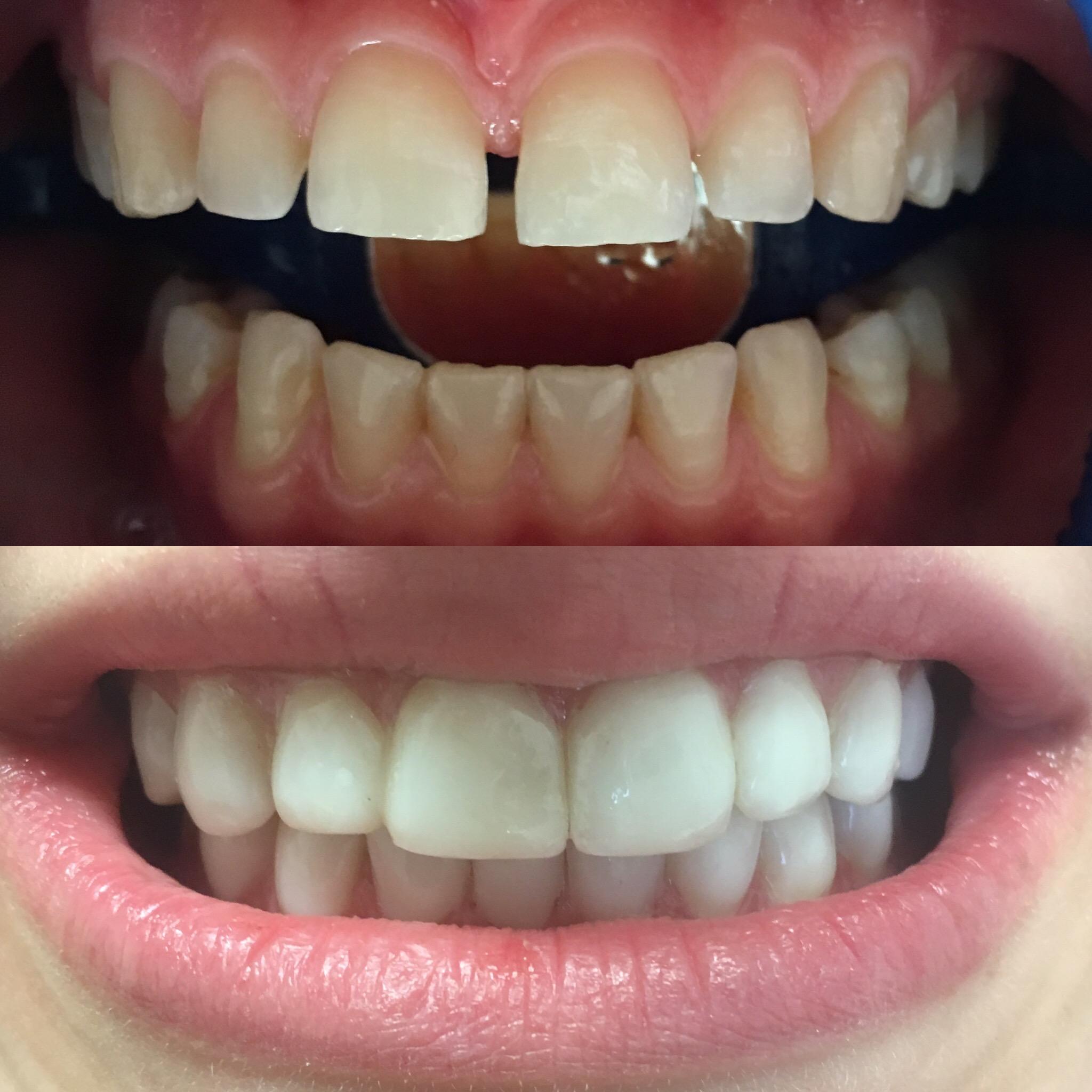 Avant / après : transformation du sourire avec facettes en porcelaine