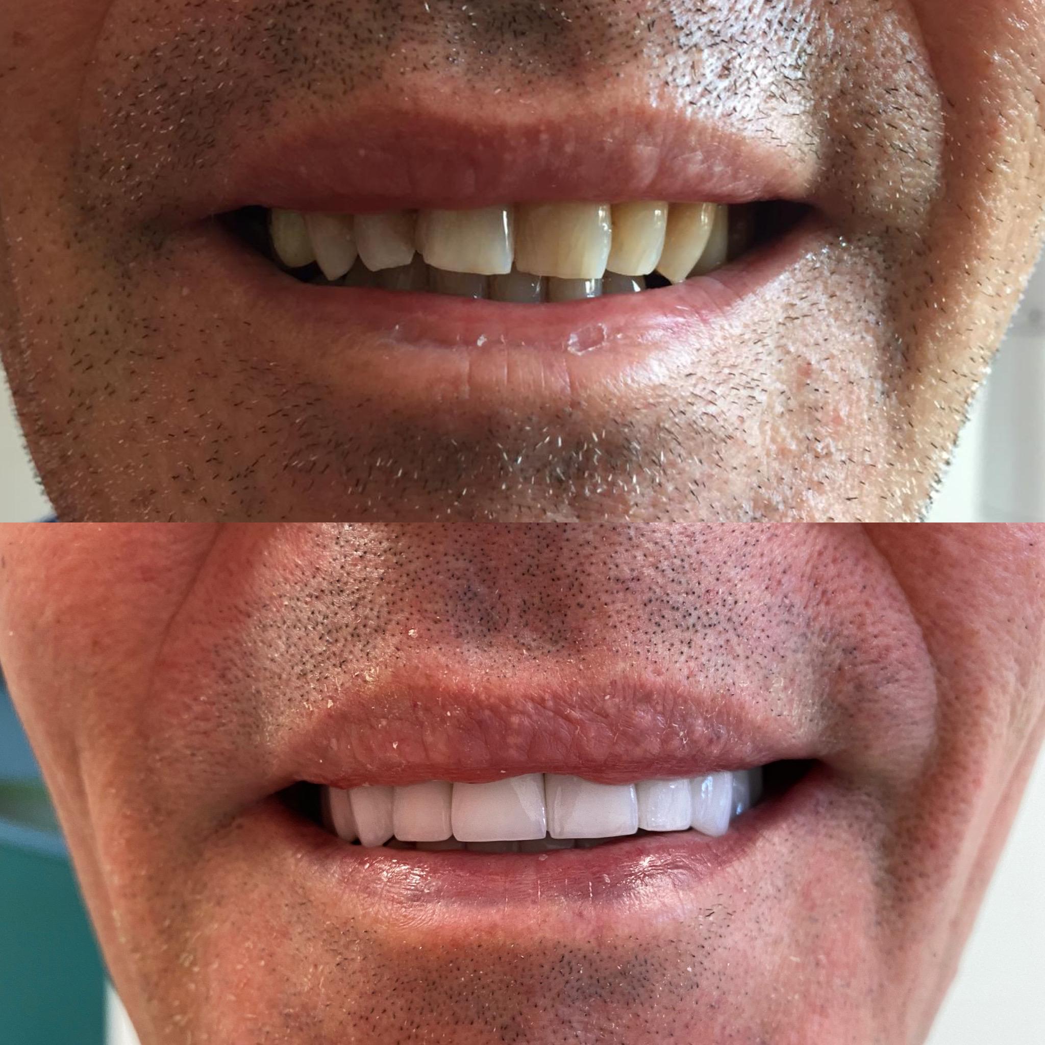 Avant / après : Hollywood smile avec facettes naturelles
