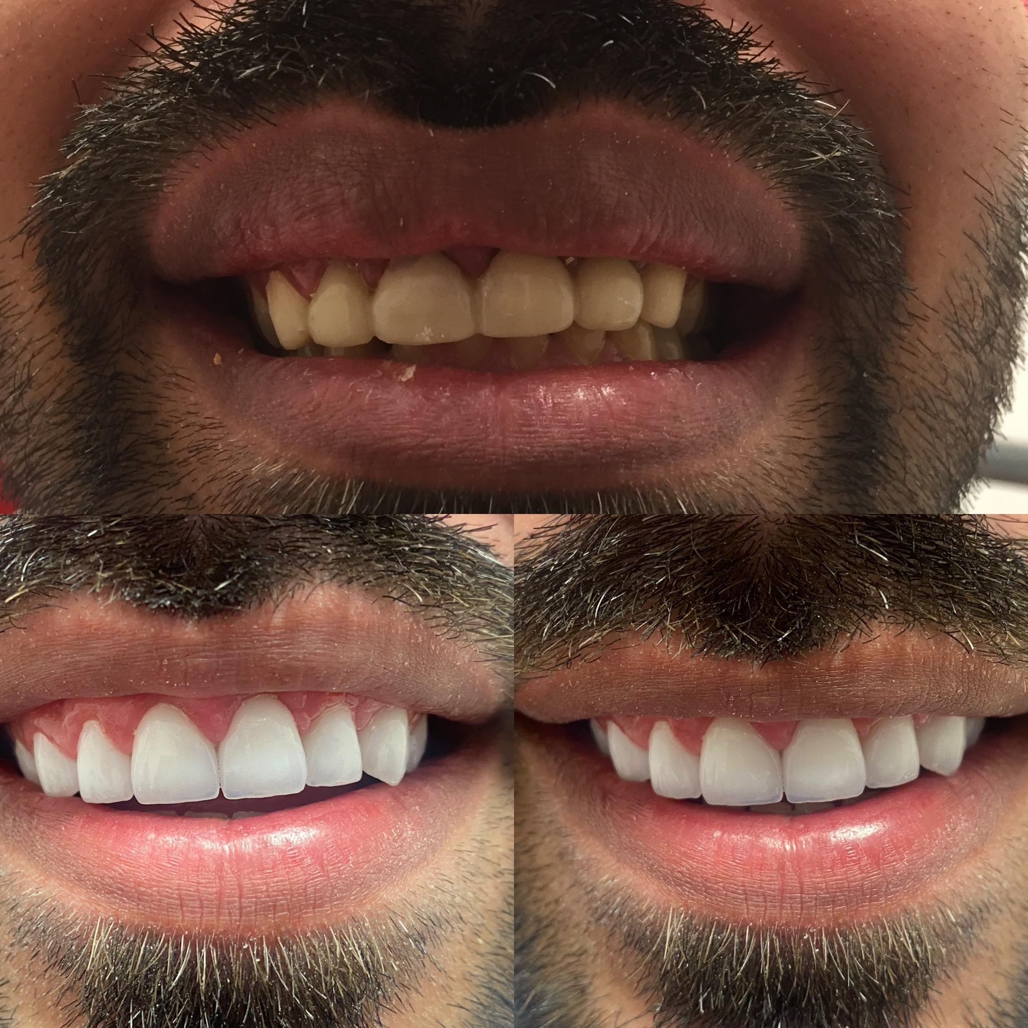 Avant / après : restauration complète du sourire